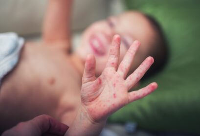 Hand, Foot, and Mouth Disease in Children
