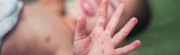 Hand, Foot, and Mouth Disease in Children