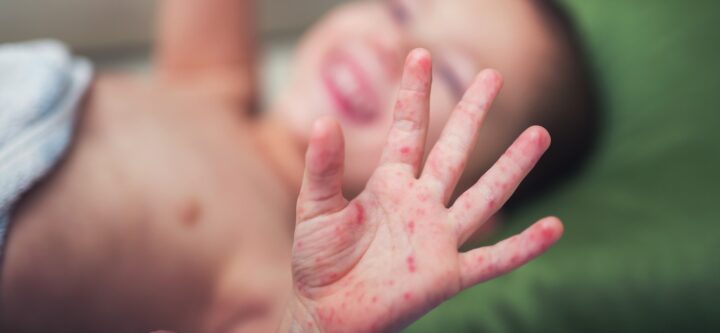 Hand, Foot, and Mouth Disease in Children