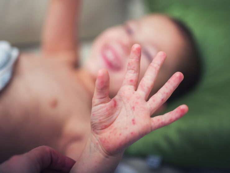 Hand, Foot, and Mouth Disease in Children