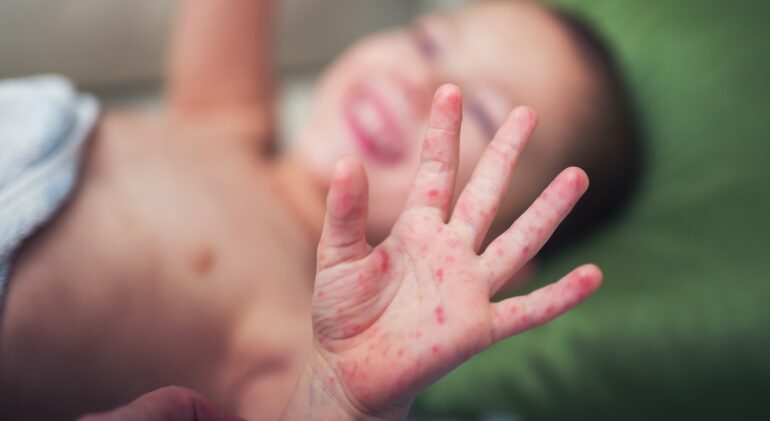 Hand, Foot, and Mouth Disease in Children Hand, Foot, and Mouth Disease in Children
